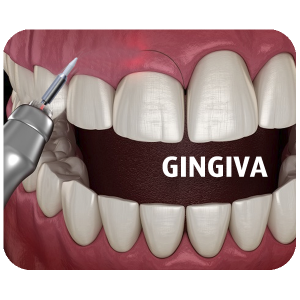Gingiva